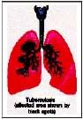 Biology, Class 9, Health and Disease, Types of Diseases, Symptoms